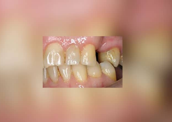 Dental-Bridge-before-1