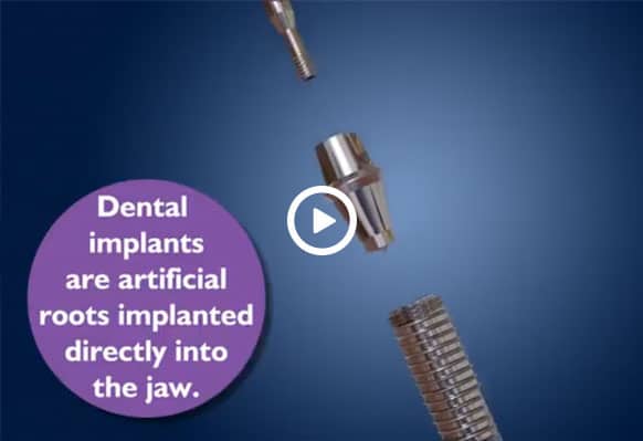 Dental-implants-01