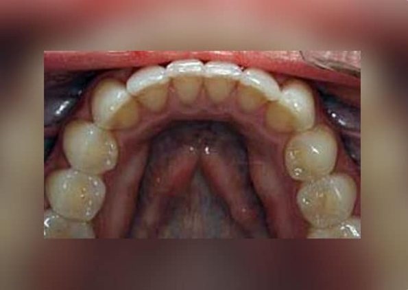 Lingual-Orthodontics-after