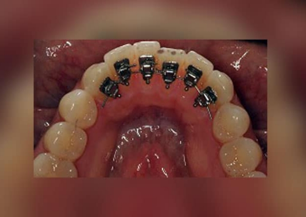 Lingual-Orthodontics-before