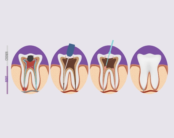 root-canal-treatment-2