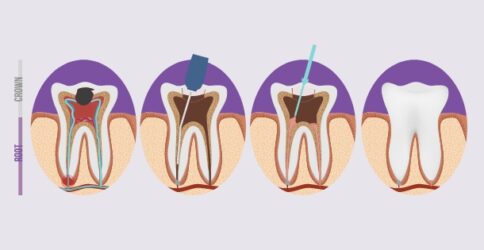 root-canal-treatment-2