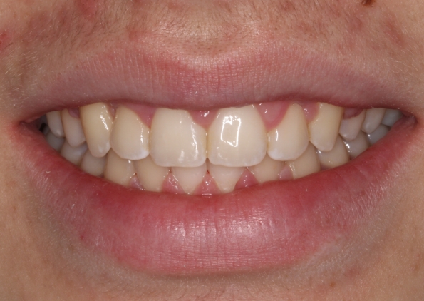 teeth-straightening-after-1