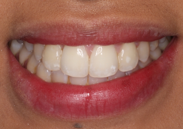teeth-straightening-after-2