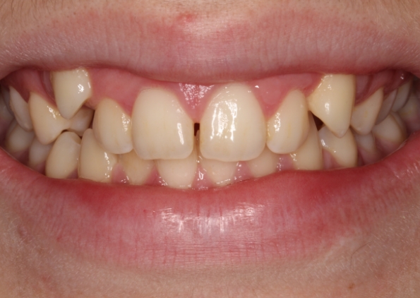 teeth-straightening-before-1