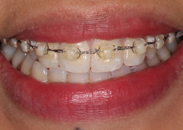 teeth-straightening-before-2