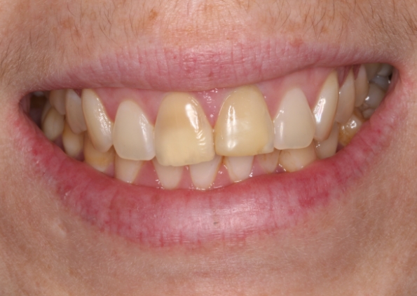 teeth-white-before-1