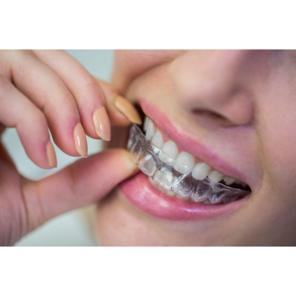 Benefits of Invisalign for Adults